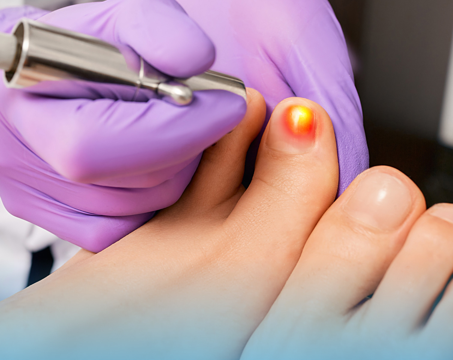 Cold Laser Fungal Treatment