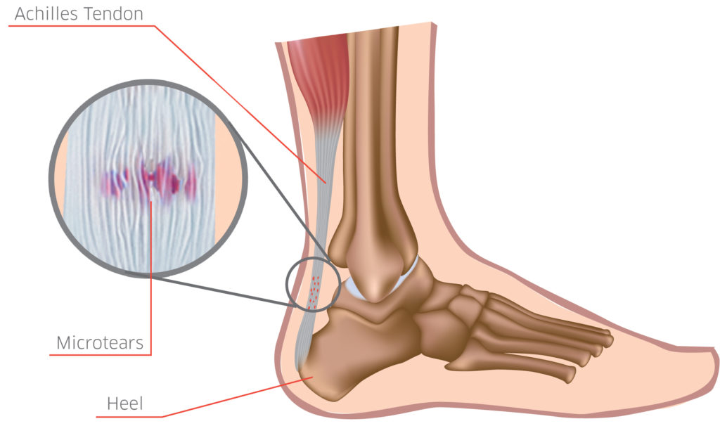 achilles tendon hurts to touch