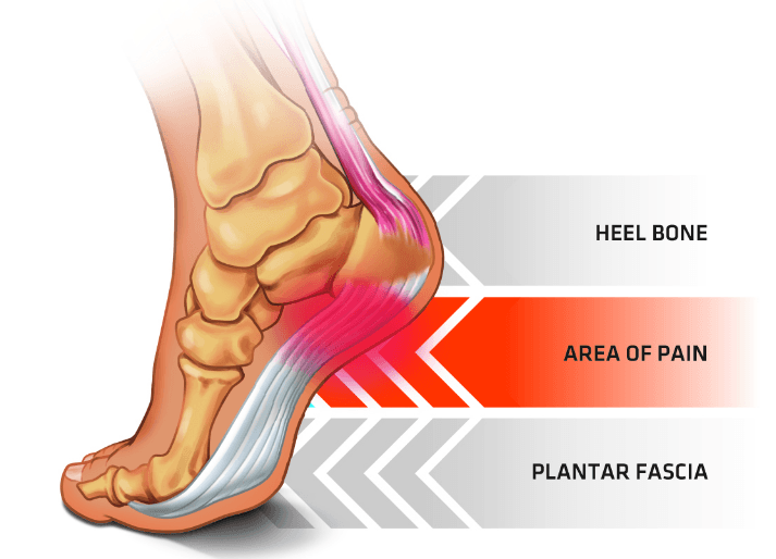 heel pain inflammation