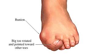 Bunions Treatment