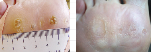SWIFT Wart Therapy for Plantar Warts