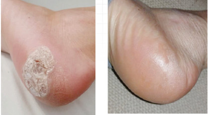 SWIFT Wart Therapy for Plantar Warts