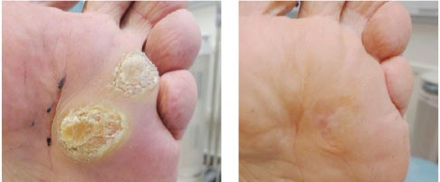 SWIFT Wart Therapy for Plantar Warts