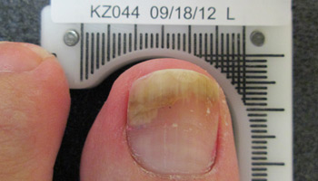 Cold Laser Therapy for Fungal Nail Infections