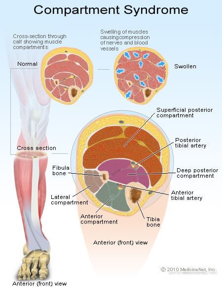 Compartment Syndrome Treatment