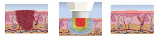 SWIFT Wart Therapy for Plantar Warts