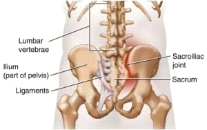 Sacroiliac Joint Dysfunction
