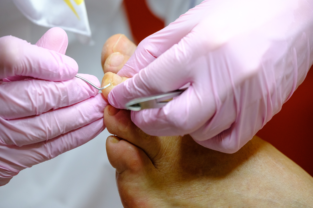 Ingrown Toenail Treatment & Permanent Nail Correction