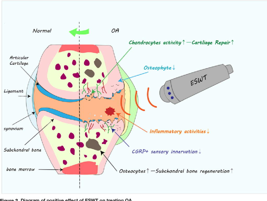 Non Surgical Treatment for Knee Osteoarthritis